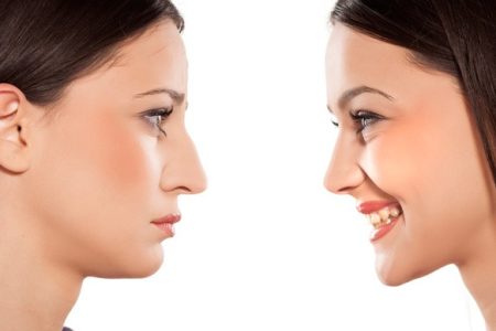 rinoplastia-solucion-nariz